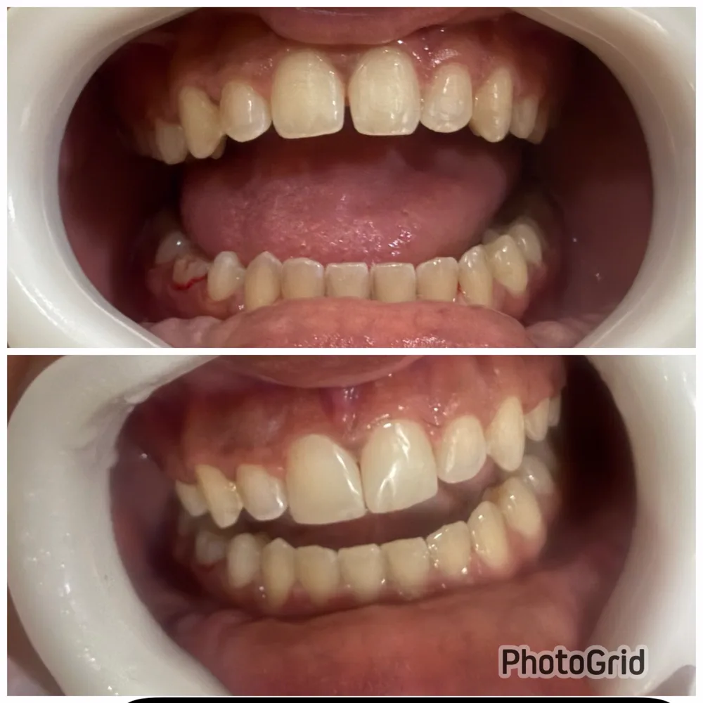 Antes e depois reabilitação dental