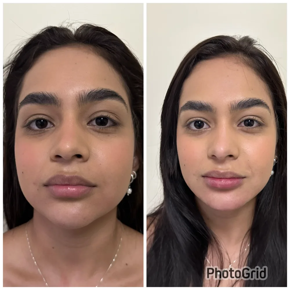 Antes e depois harmonização facial