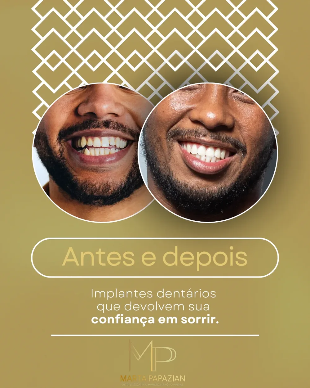 Antes e depois de implantes dentários