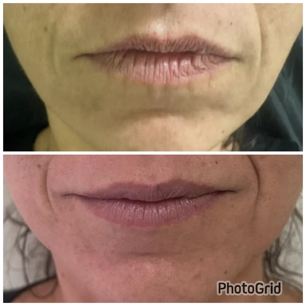 Antes e depois preenchimento labial