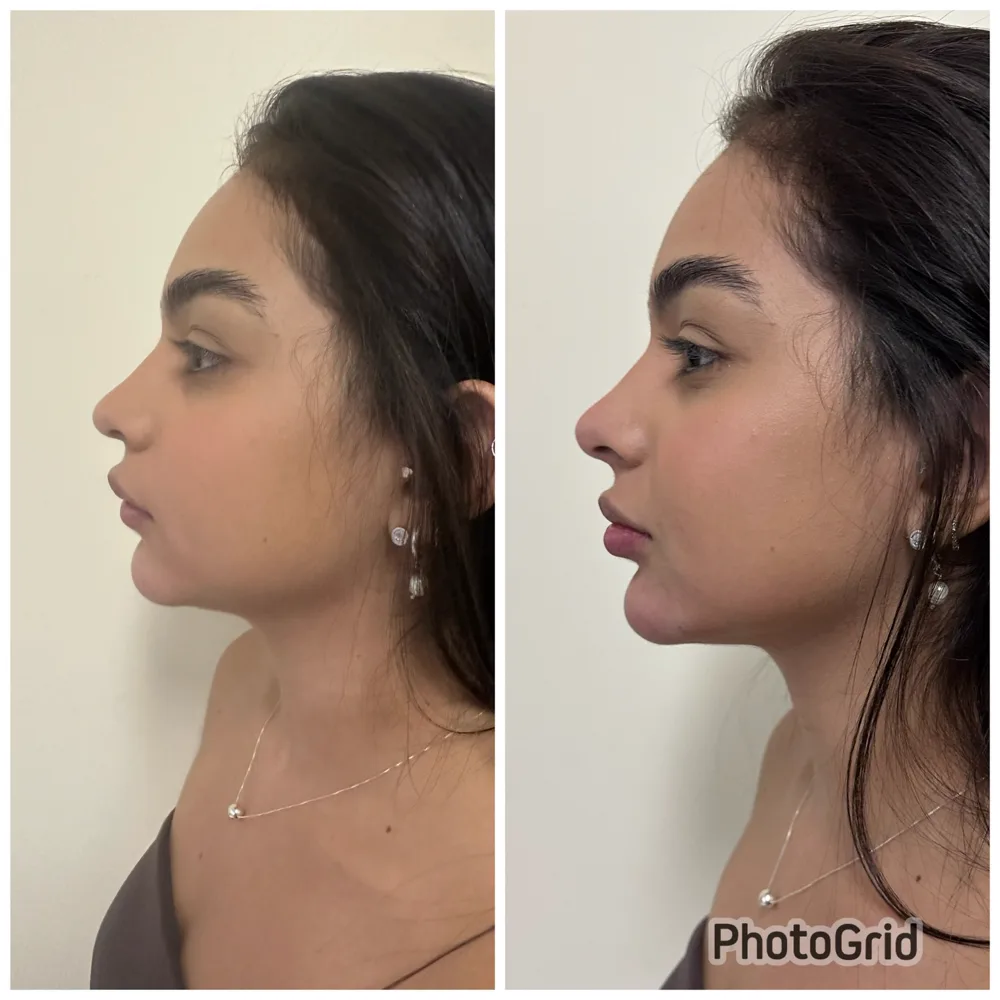 Antes e depois rinomodelação